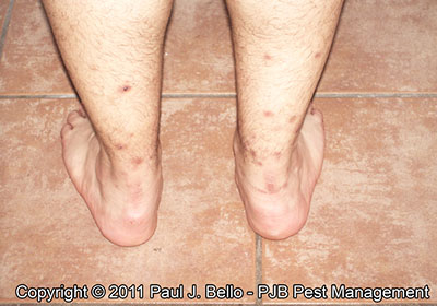 Bed Bug Bites Bed Bug Bites