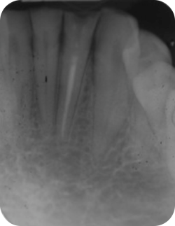 Original PA before Retreatment