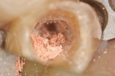 Gutta Percha Fragments in Canal at High Magnification