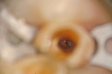 Note Small Amount of Gutta Percha in Canal Under Scope
