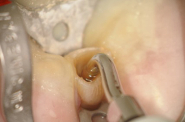 Using Ultrasonic TUFI Tip with Water to Flush Out Last Bit of GP in Canal