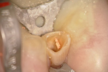 Last Bit Removed with Ultrasonics