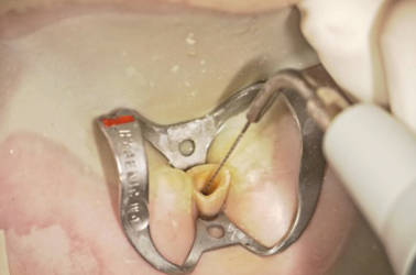Ultrasonic File (Satelec) to Help with Irrigation