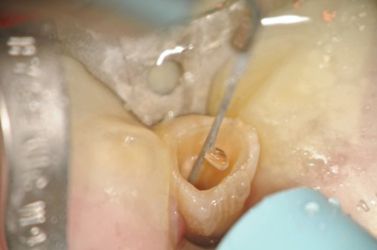 Laser at Work to Remove Smear Layer and to Disinfect Canal Prior to Obturation