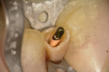 Trial Cone in Place