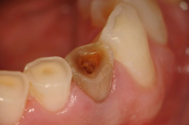 Preop Photograph of Tooth