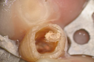 Close Up View of Gutta Percha
