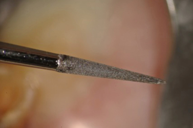 TUFI No 1 Ultrasonic Tip (San Diego Swiss Dental Machining)