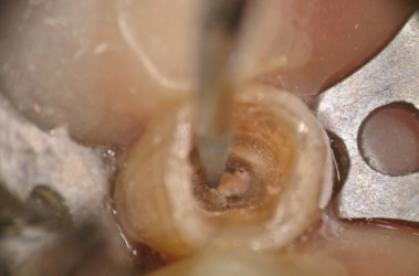 Tip Placed on GP Dry to Remove Coronal Portion of GP Easily