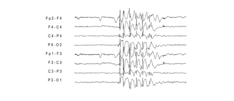 photosensitive epilepsy brain activity