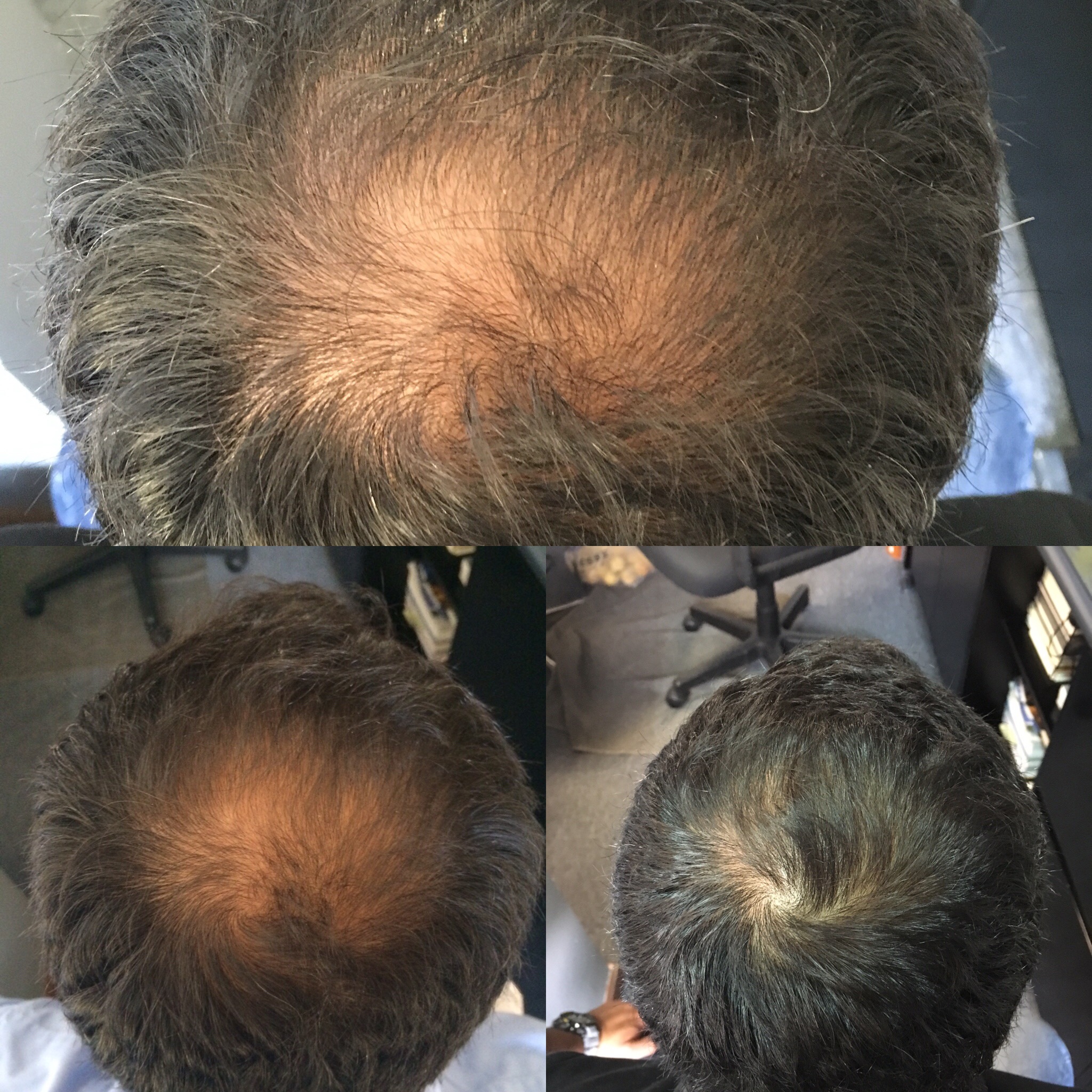 Help Hair Shake Before and After Pictures for Hair Loss
