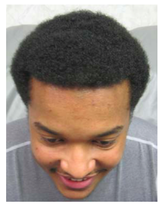 before-after-pictures-with-help-hair-shake-on-young-african-american-male.png