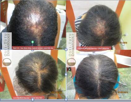 Central Centrifugal Cicatricial Alopecia (CCCA). What is ...