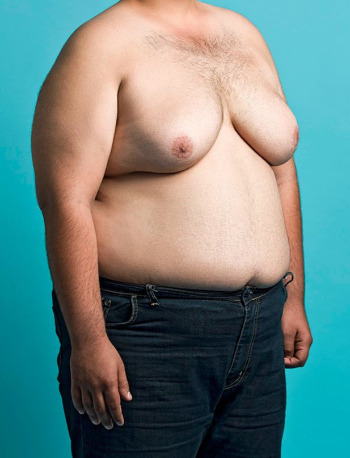 Gynecomastia and associated fat