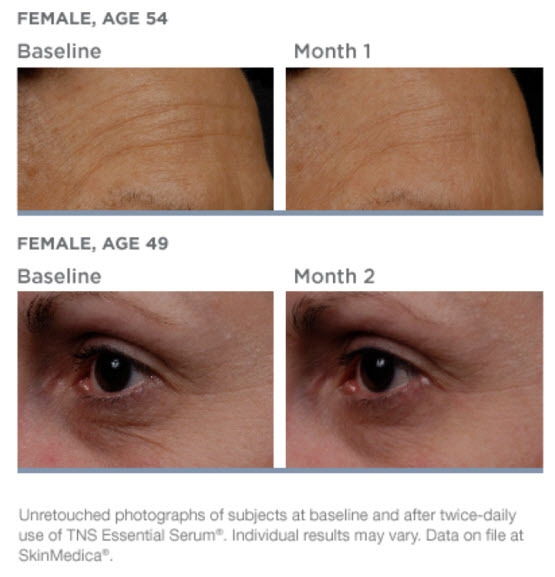 tns-before-after-age-54-48385.1458163796.1280.1280.jpg tns-before-after-age-54-48385.1458163796.1280.1280.jpg